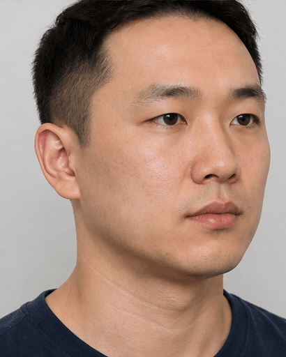Jaw Slimming (Masseter): before