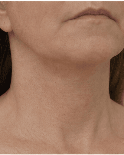 Neck Band Softening: after
