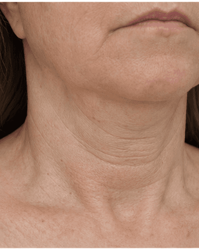 Neck Band Softening: before