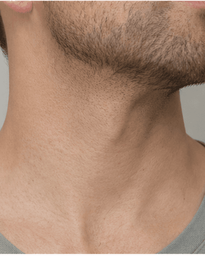 Neck Band Softening: after