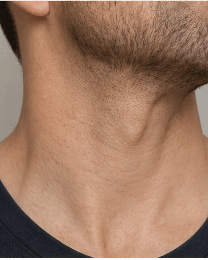 Neck Band Softening: before