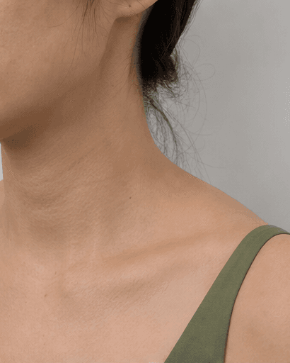 Trapezius Slimming: after