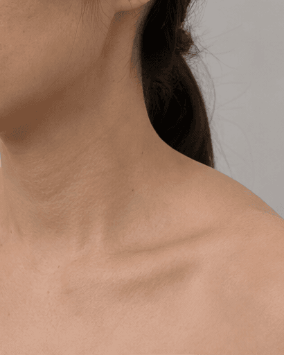 Trapezius Slimming: before