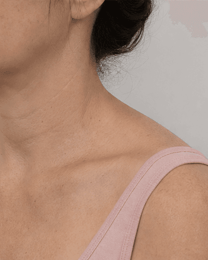 Trapezius Slimming: after