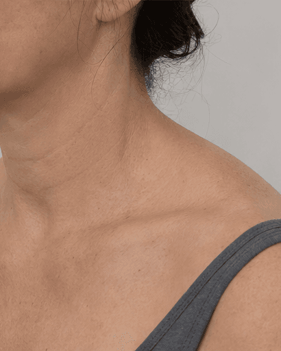 Trapezius Slimming: before