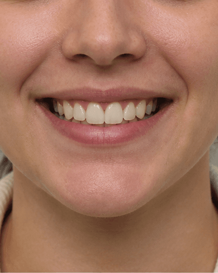 Clear Aligners: after