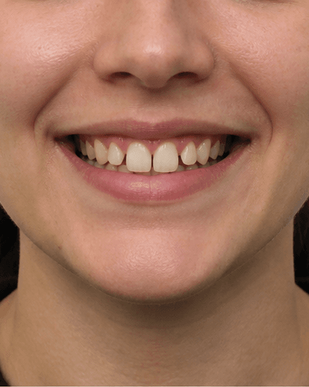 Clear Aligners: before