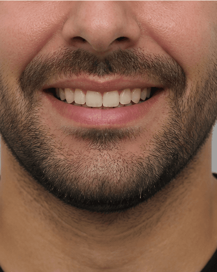 Clear Aligners: after