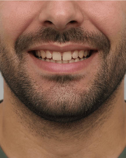 Clear Aligners: before