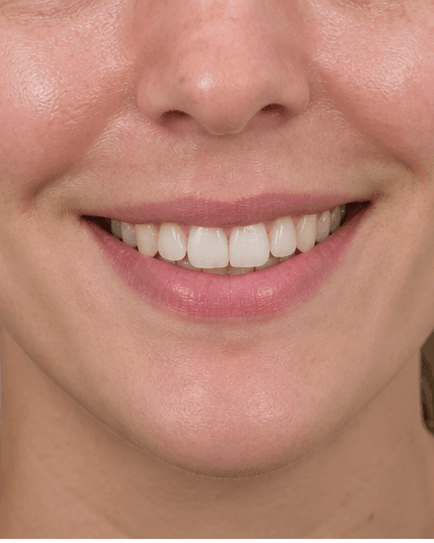 Composite Bonding: after