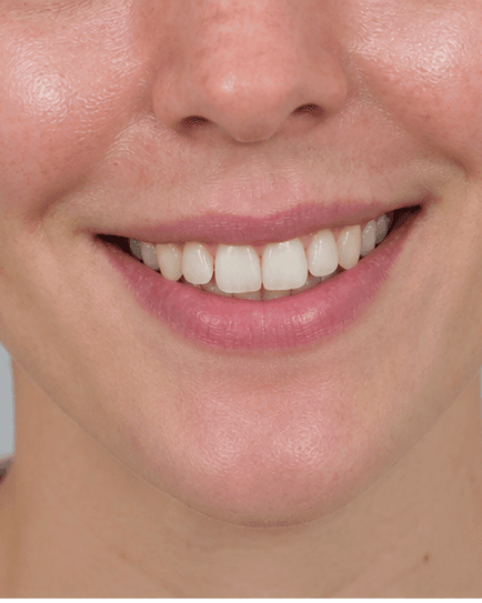 Composite Bonding: before