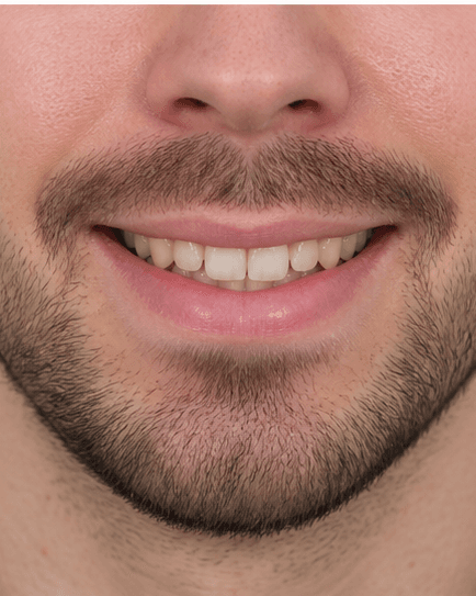 Composite Bonding: before