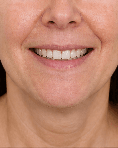 Dental Aesthetic Consult: after