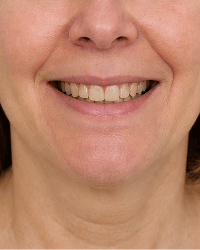 Dental Aesthetic Consult: before