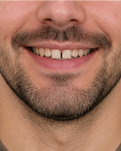 Dental Aesthetic Consult: before