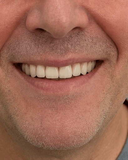 Dental Implant: after