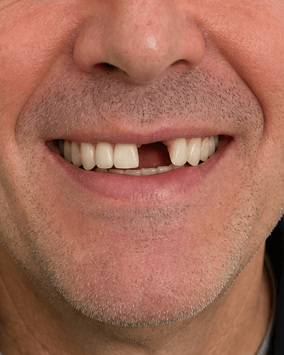 Dental Implant: before