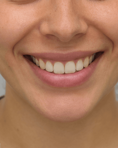 Gum Contouring: after