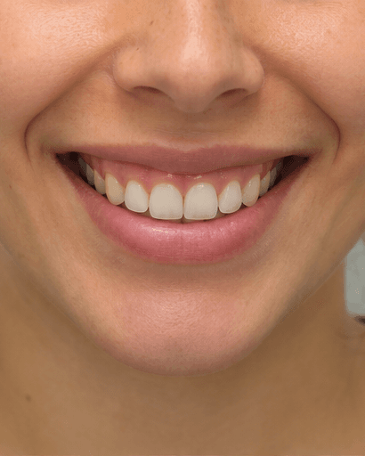 Gum Contouring: before