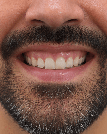 Gum Contouring: before