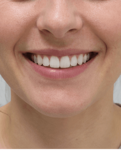 Supervised Home Whitening: after