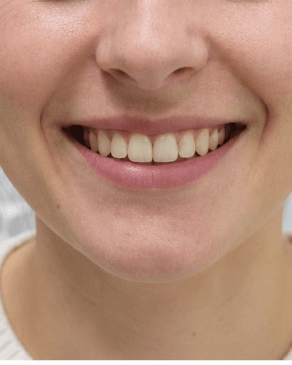 Supervised Home Whitening: before