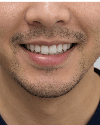 Supervised Home Whitening: after