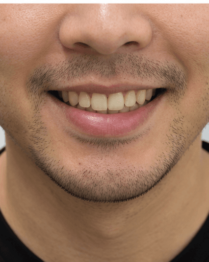 Supervised Home Whitening: before