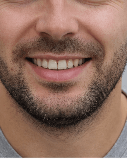 Porcelain Veneers: before