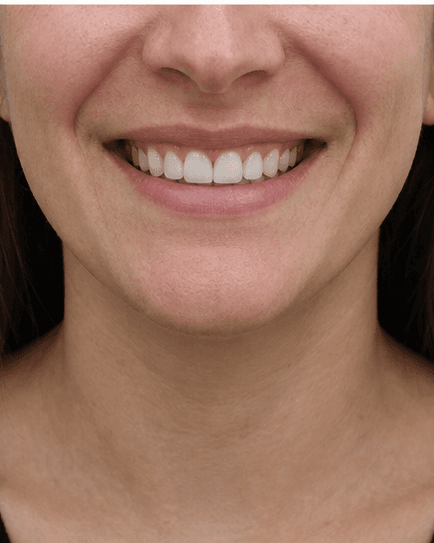 Porcelain Veneers: after