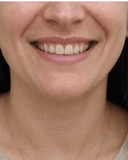 Porcelain Veneers: before