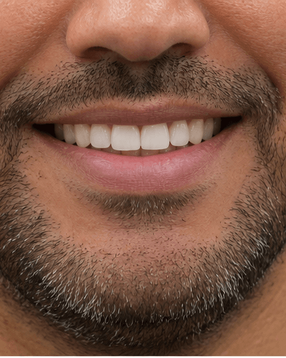 Scaling & Polishing: after
