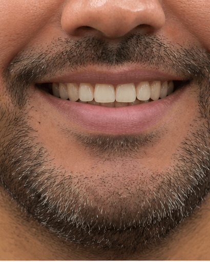 Scaling & Polishing: before