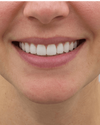 Scaling & Polishing: after
