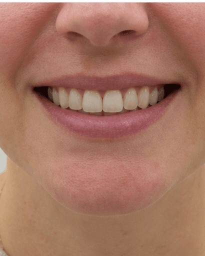 Scaling & Polishing: before