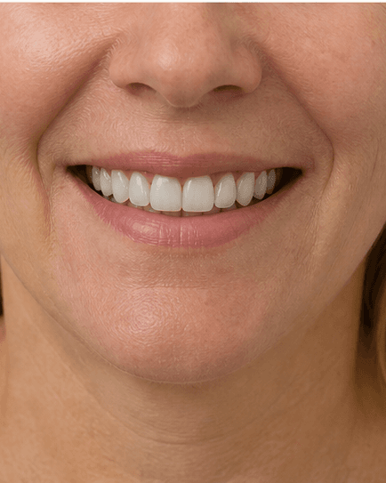 Smile Design Consult: after