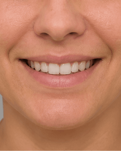 Smile & Lip Balance: before