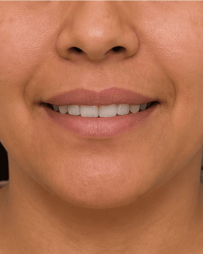 Smile & Lip Balance: before