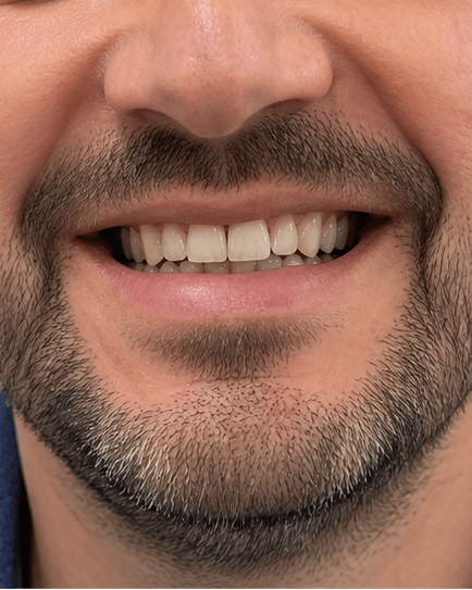 Full Smile Makeover: before