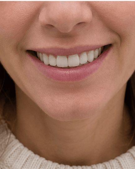 Full Smile Makeover: after