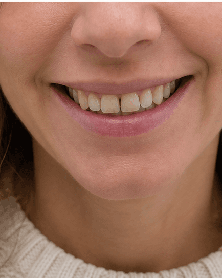 Full Smile Makeover: before