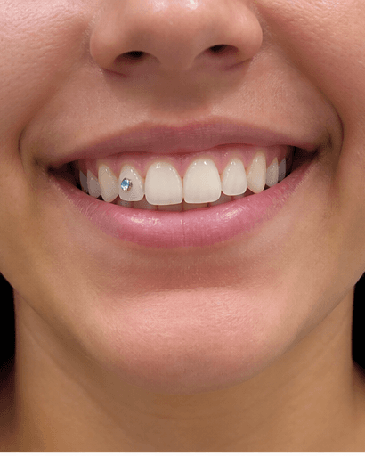 Tooth Gem Application: after