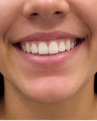 Tooth Gem Application: before