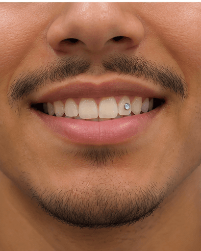 Tooth Gem Application: after