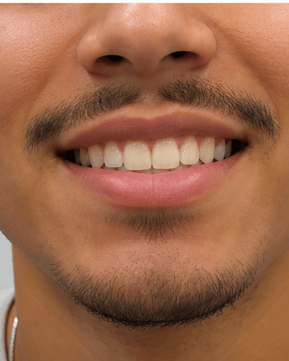 Tooth Gem Application: before