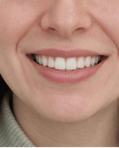 Professional Whitening: after