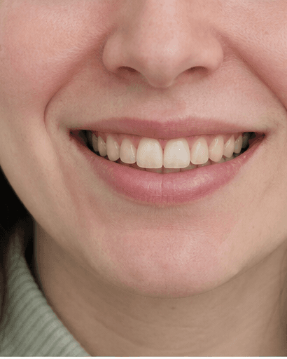 Professional Whitening: before