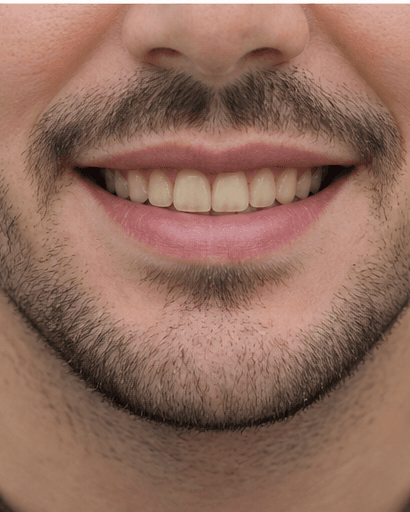 Professional Whitening: before