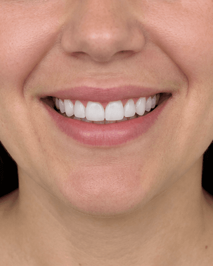 Veneers: after