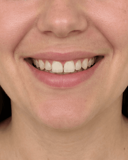 Veneers: before